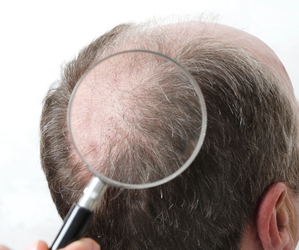 Adam saç ekimi için saçlarını muayene ettiriyor